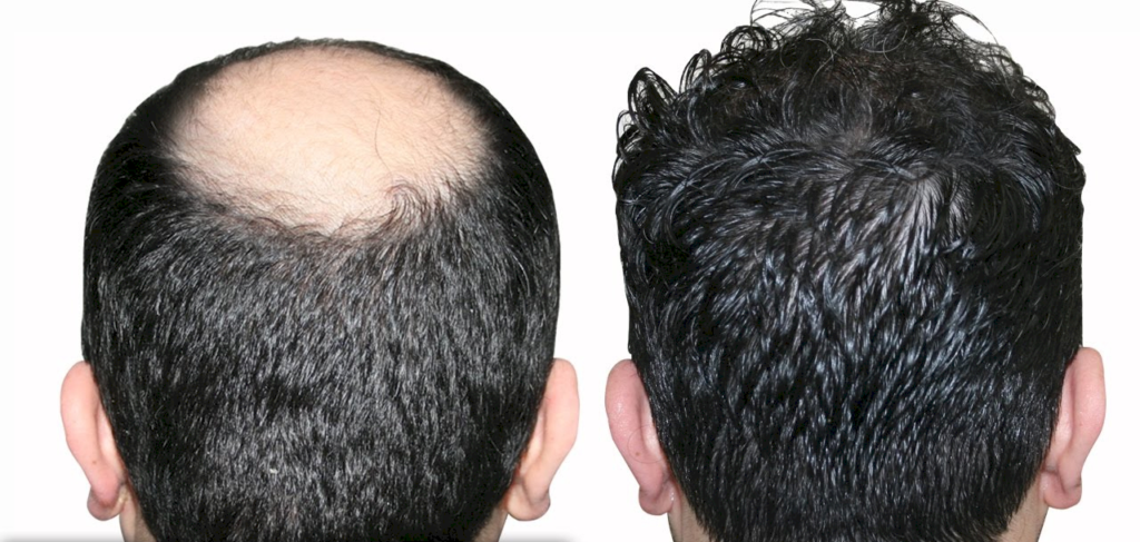 Hair Transplantation in Turkey